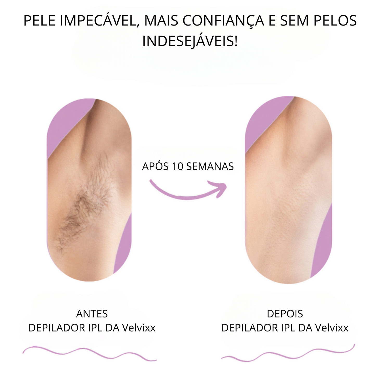 Velvixx Lumélia IPL, elimina os pêlos de forma definitiva, sem dor e em casa